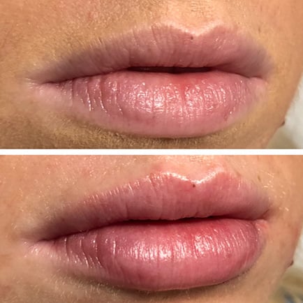 Juvederm Lip Filler Before and After