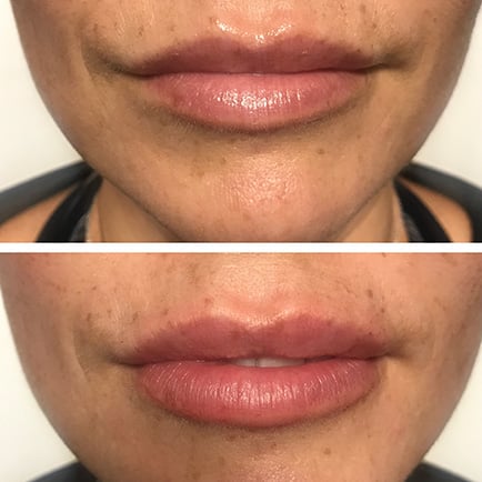 Juvederm Lip Filler Before and After 2
