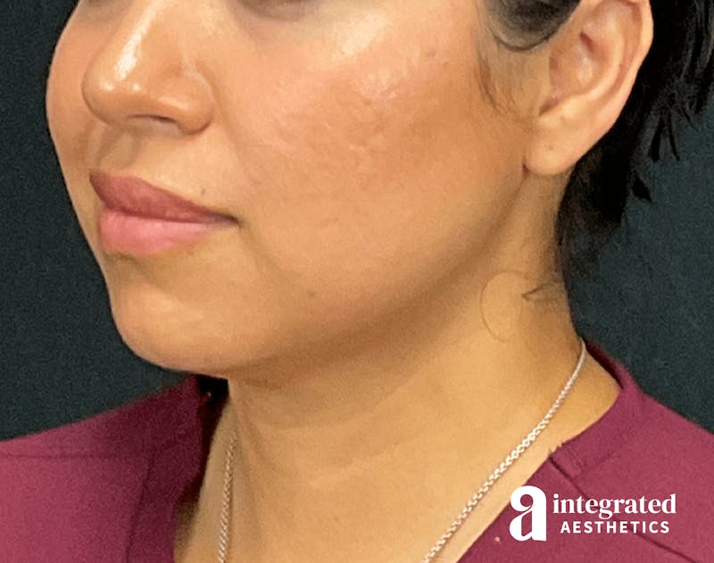 FaceTite & AccuTite Before & After Gallery - Patient 133213637 - Image 6
