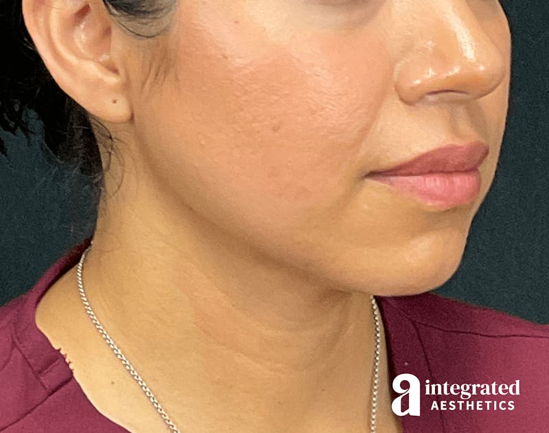 FaceTite & AccuTite Before & After Gallery - Patient 133213637 - Image 4