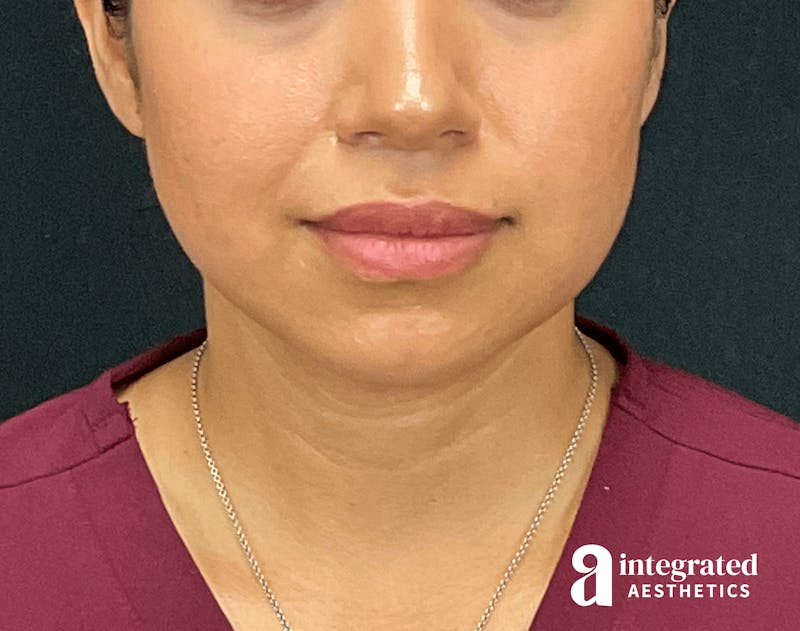 FaceTite & AccuTite Before & After Gallery - Patient 133213637 - Image 2