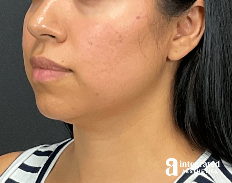 FaceTite & AccuTite Before & After Gallery - Patient 133213637 - Image 5