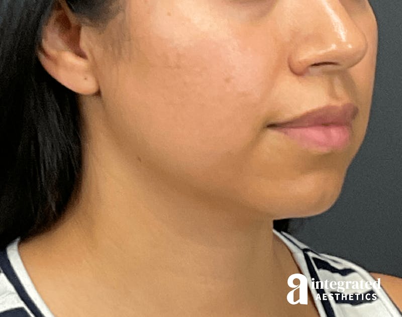 FaceTite & AccuTite Before & After Gallery - Patient 133213637 - Image 3