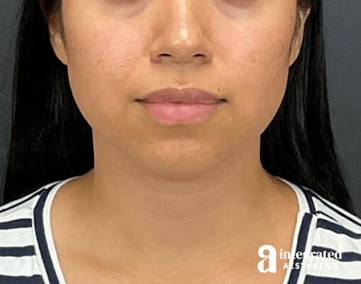 FaceTite & AccuTite Before & After Gallery - Patient 133213637 - Image 1