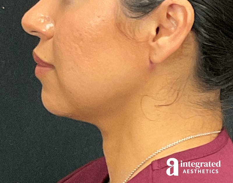 FaceTite & AccuTite Before & After Gallery - Patient 133213637 - Image 10