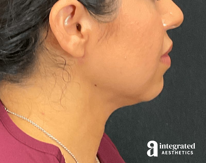 FaceTite & AccuTite Before & After Gallery - Patient 133213637 - Image 8