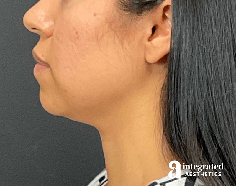 FaceTite & AccuTite Before & After Gallery - Patient 133213637 - Image 9