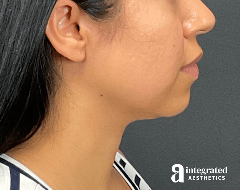 FaceTite & AccuTite Before & After Gallery - Patient 133213637 - Image 7