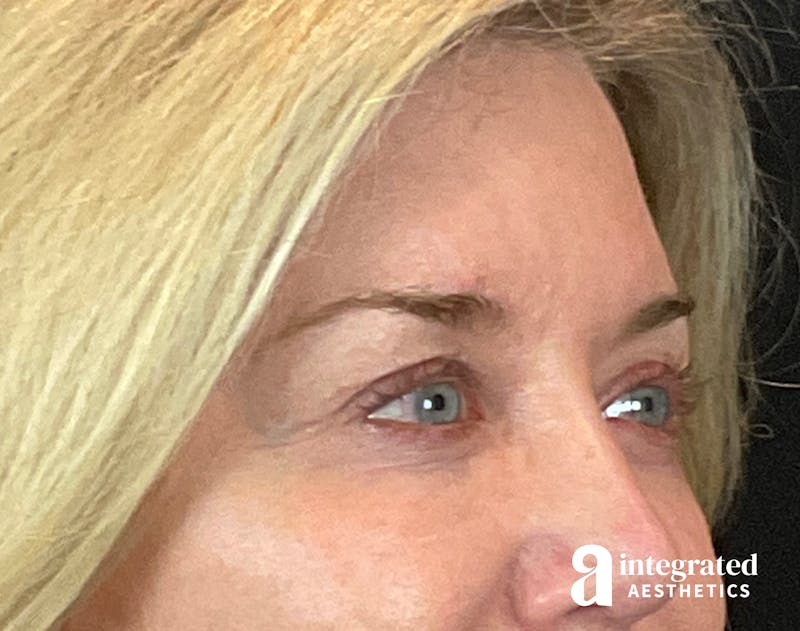 Blepharoplasty Before & After Gallery - Patient 157150793 - Image 4