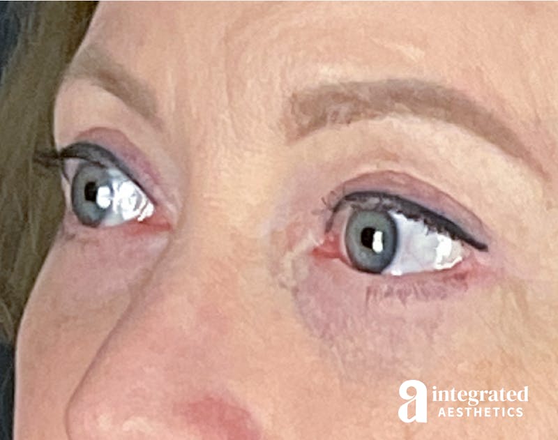 Blepharoplasty Before & After Gallery - Patient 133211156 - Image 4