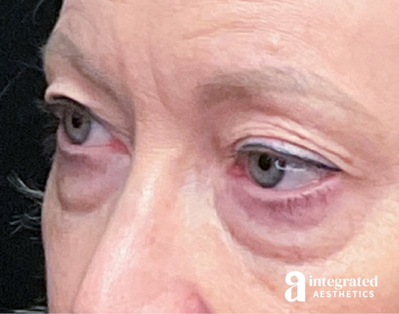 Blepharoplasty Before & After Gallery - Patient 133211156 - Image 3