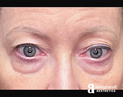 Blepharoplasty Before & After Gallery - Patient 133211156 - Image 1