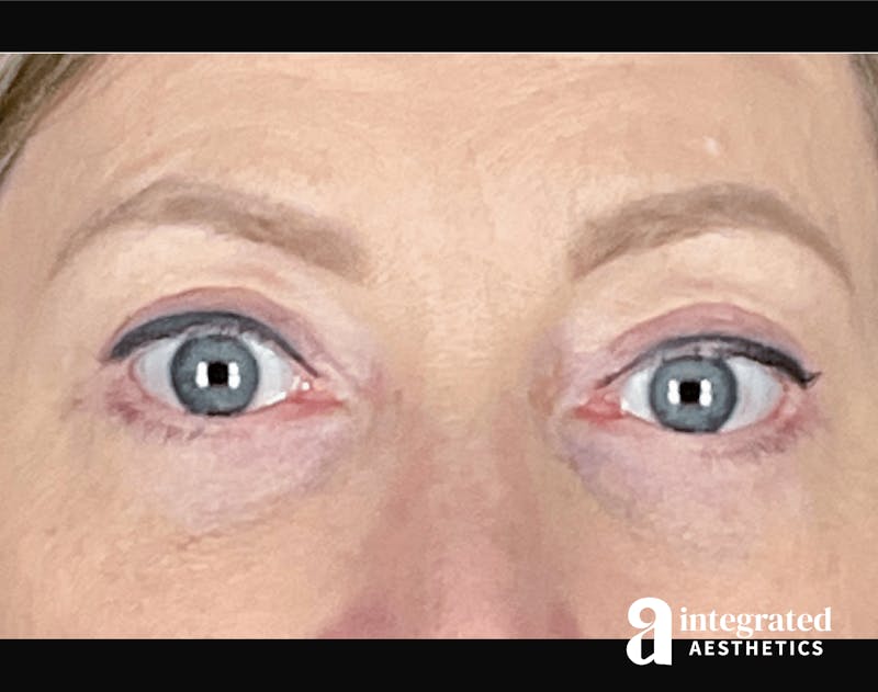 Blepharoplasty Before & After Gallery - Patient 133211156 - Image 2