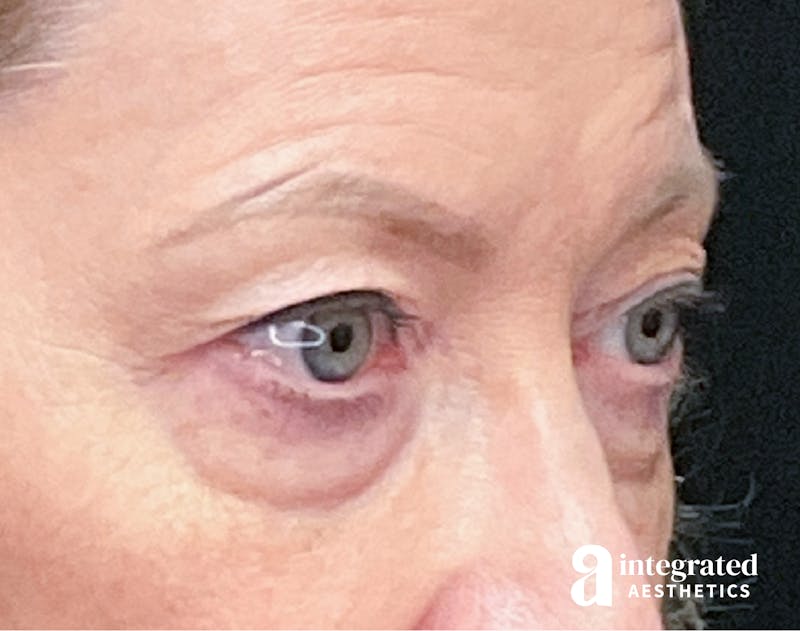 Blepharoplasty Before & After Gallery - Patient 133211156 - Image 5
