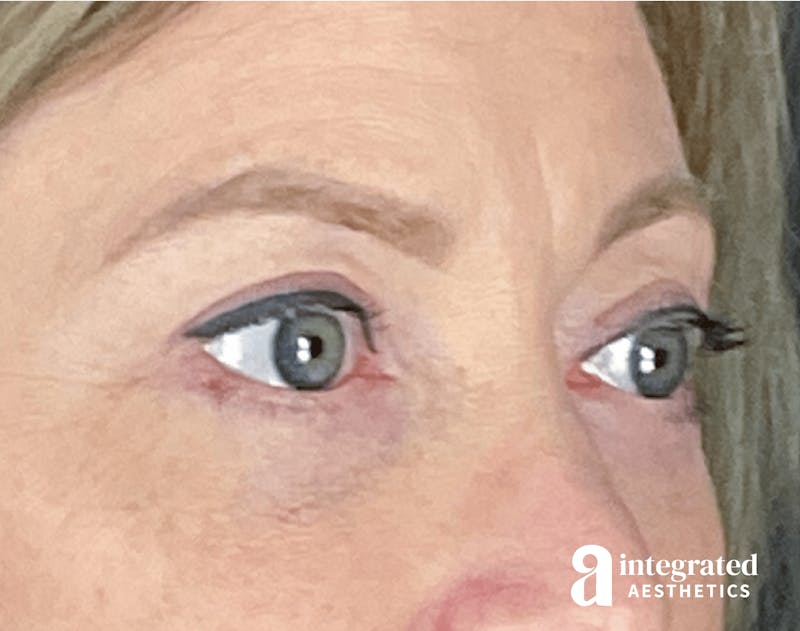 Blepharoplasty Before & After Gallery - Patient 133211156 - Image 6