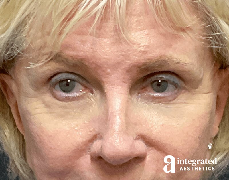 Blepharoplasty Before & After Gallery - Patient 133211182 - Image 2