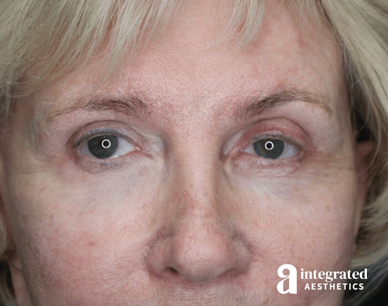 Blepharoplasty Before & After Gallery - Patient 133211182 - Image 1