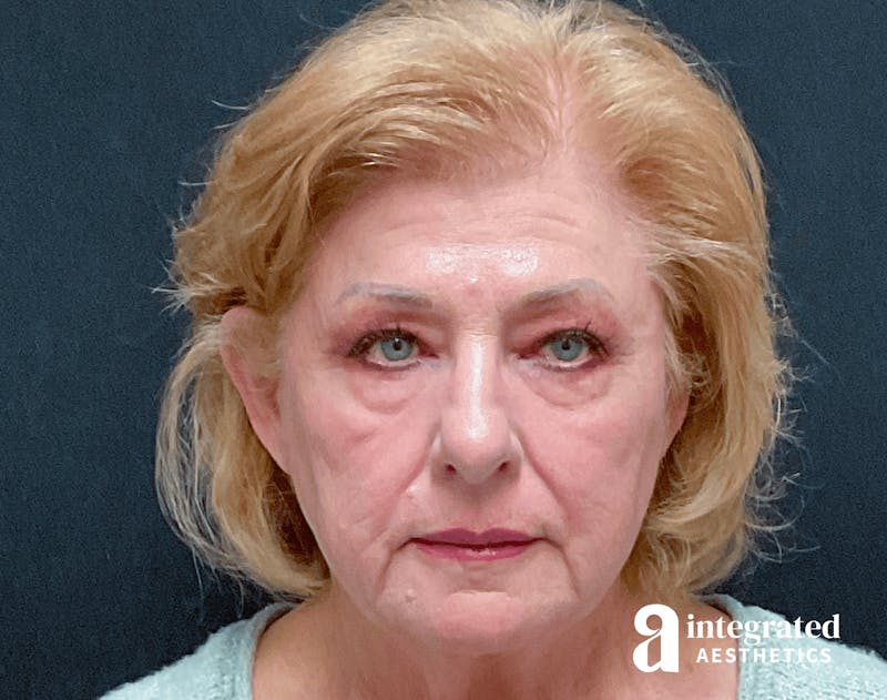 Blepharoplasty Before & After Gallery - Patient 133211225 - Image 1