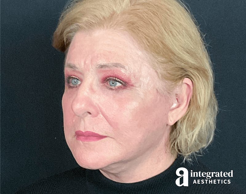 Blepharoplasty Before & After Gallery - Patient 133211225 - Image 4