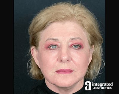 Blepharoplasty Before & After Gallery - Patient 133211225 - Image 2
