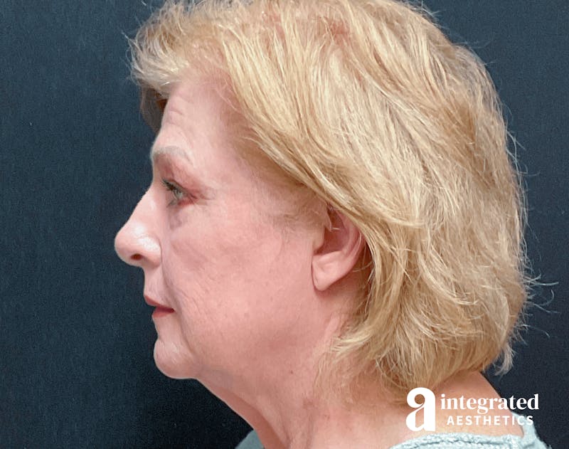 Blepharoplasty Before & After Gallery - Patient 133211225 - Image 5