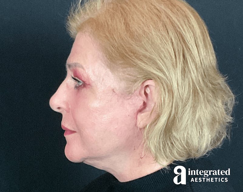 Blepharoplasty Before & After Gallery - Patient 133211225 - Image 6