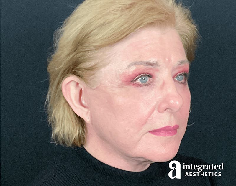 Blepharoplasty Before & After Gallery - Patient 133211225 - Image 8