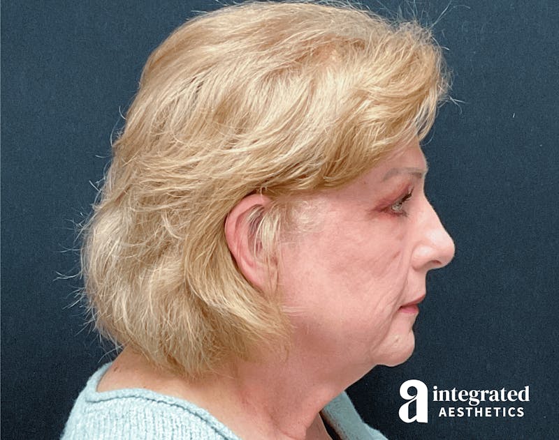 Blepharoplasty Before & After Gallery - Patient 133211225 - Image 9