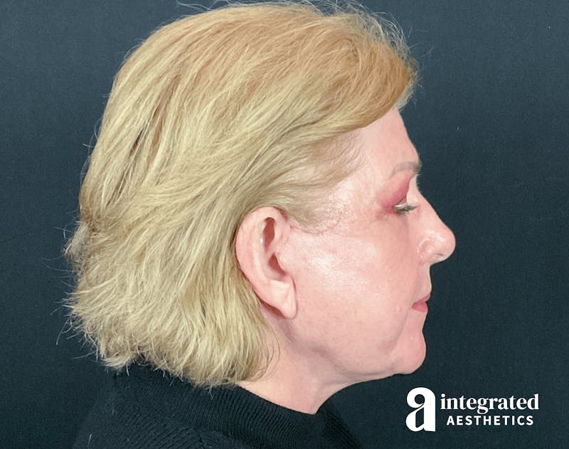 Blepharoplasty Before & After Gallery - Patient 133211225 - Image 10