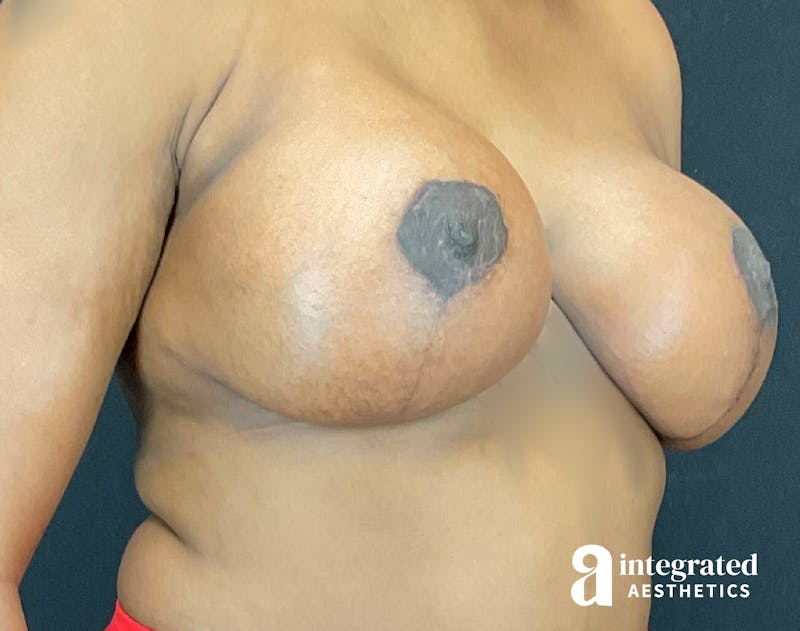Breast Augmentation Before & After Gallery - Patient 133211286 - Image 6