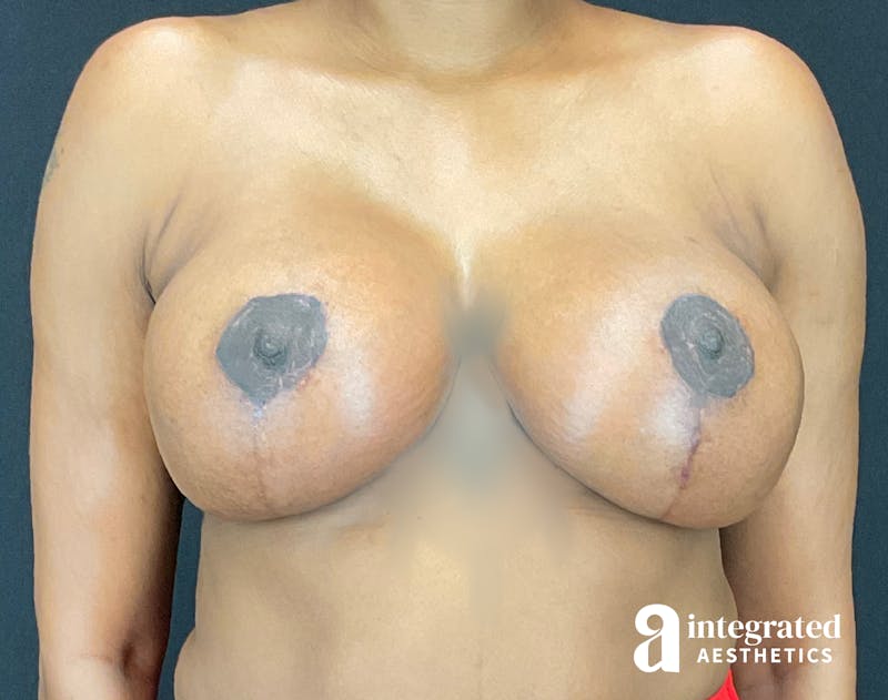 Breast Augmentation Before & After Gallery - Patient 133211286 - Image 2