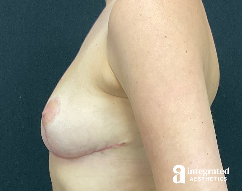 Breast Augmentation Before & After Gallery - Patient 133211313 - Image 8