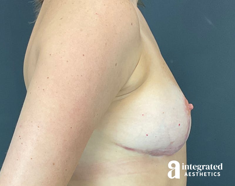 Breast Augmentation Before & After Gallery - Patient 133211313 - Image 9