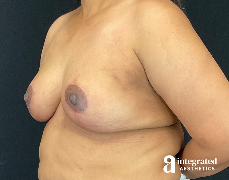 Breast Augmentation Before & After Gallery - Patient 133211391 - Image 4