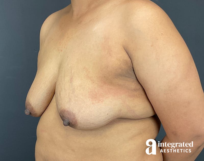 Breast Augmentation Before & After Gallery - Patient 133211391 - Image 3