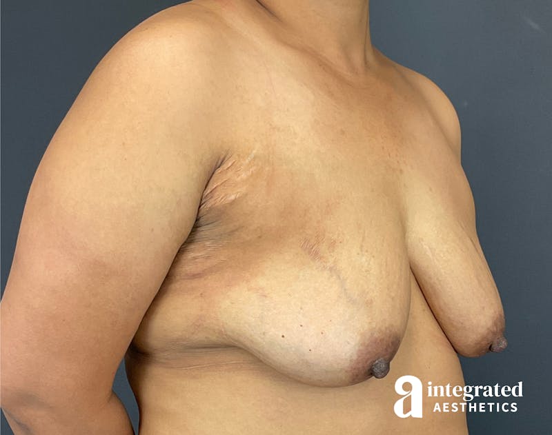 Breast Augmentation Before & After Gallery - Patient 133211391 - Image 5
