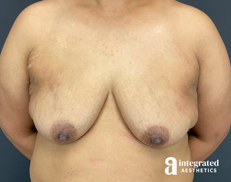 Breast Augmentation Before & After Gallery - Patient 133211391 - Image 1
