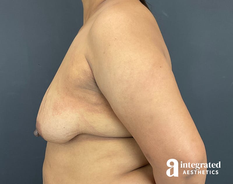 Breast Augmentation Before & After Gallery - Patient 133211391 - Image 7