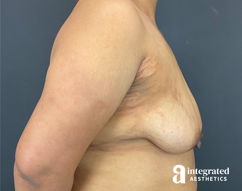 Breast Augmentation Before & After Gallery - Patient 133211391 - Image 9