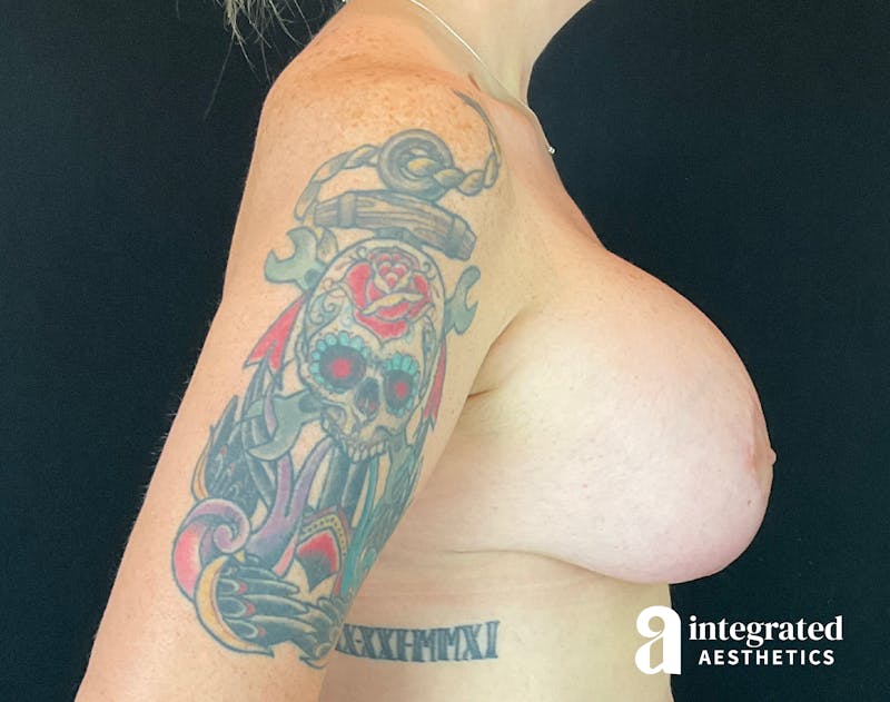 Breast Augmentation Before & After Gallery - Patient 133211415 - Image 10