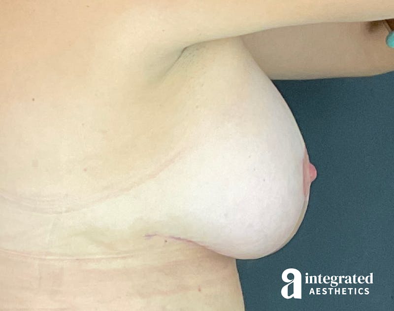 Breast Augmentation Before & After Gallery - Patient 133211532 - Image 10