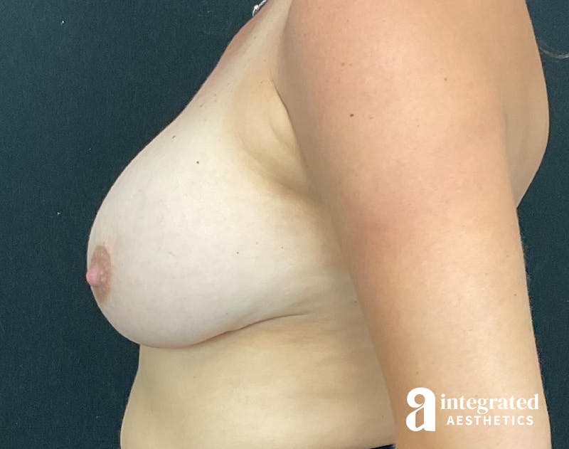 Breast Augmentation Before & After Gallery - Patient 133211532 - Image 7