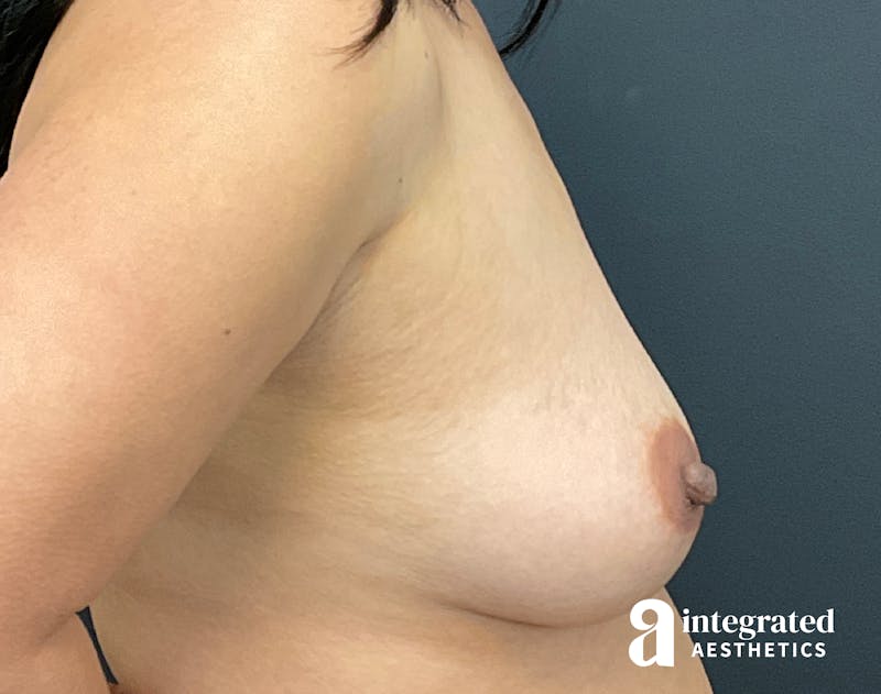 Breast Augmentation Before & After Gallery - Patient 133211563 - Image 9