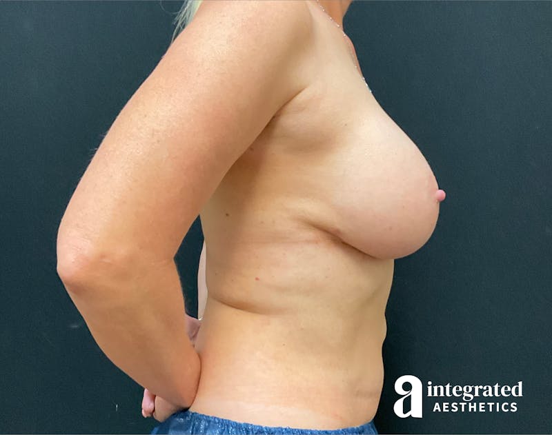 Breast Augmentation Before & After Gallery - Patient 133211573 - Image 10