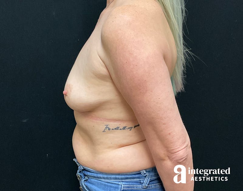 Breast Augmentation Before & After Gallery - Patient 133211573 - Image 7