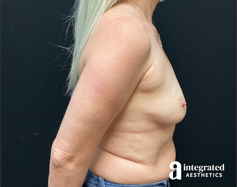 Tummy Tuck Before & After Gallery - Patient 157150307 - Image 9