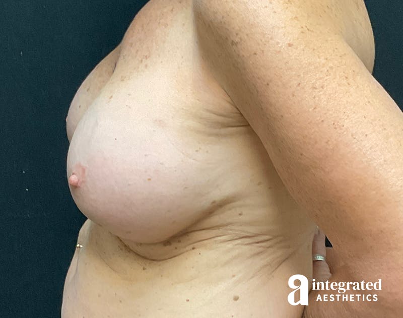 Breast Augmentation Before & After Gallery - Patient 133211607 - Image 8