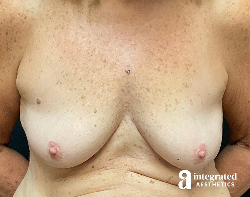 Breast Augmentation Before & After Gallery - Patient 133211607 - Image 1