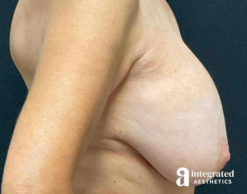 Breast Augmentation Before & After Gallery - Patient 133212378 - Image 9