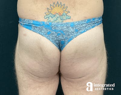 Butt Lift Before & After Gallery - Patient 133212535 - Image 2